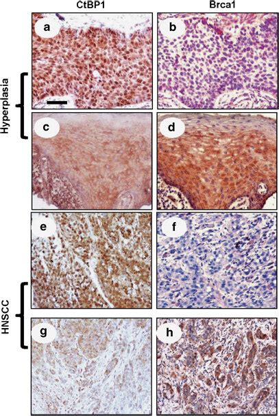 Correlation Between CtBP1 Upregulation And Brca1 Downregulation In A