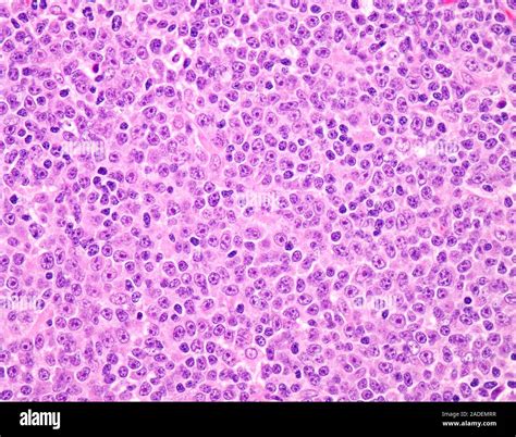 Light Micrograph Of Follicular Lymphoma High Grade Grade 3b Grade 3