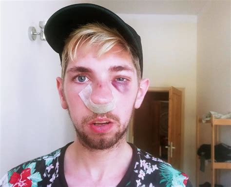 Un homme gay brutalement attaqué par des voyous ivres en plein jour Gayvox