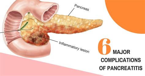 6 Major Complications of Acute Pancreatitis - Dr Maran - Springfield ...