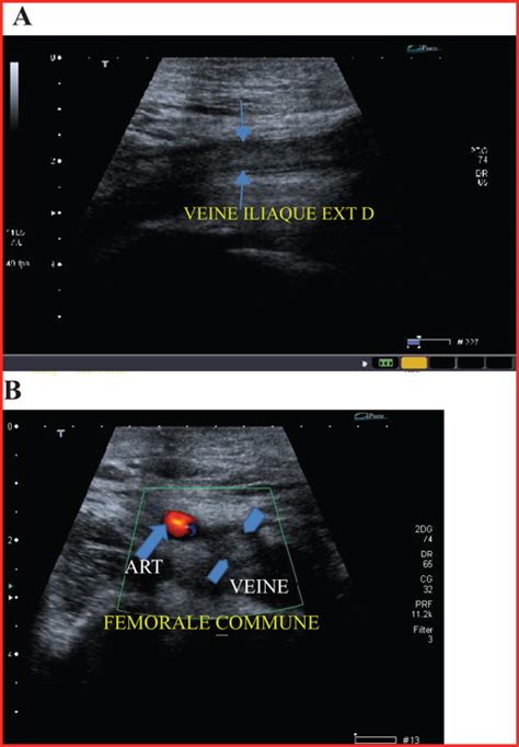 JLE Sang Thrombose Vaisseaux Thrombose Veineuse Profonde Proximale