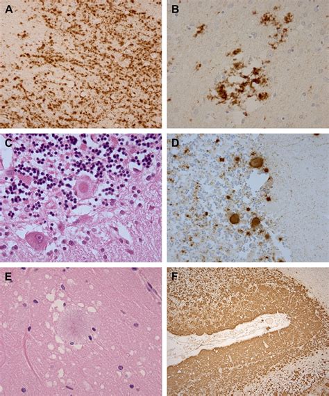 Prion Protein Disease And Neuropathology Of Prion Disease