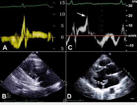 Initial Echocardiogram A B And Follow Up Echocardiogram C D A