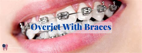 Overjet With Braces Explained Symptoms And Diagnosis