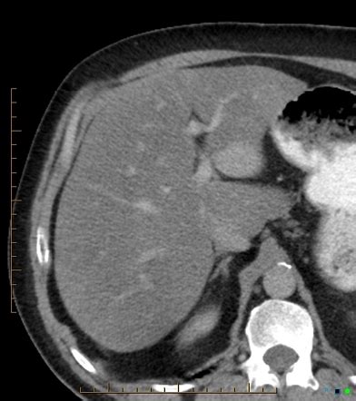 Diffuse Hepatic Steatosis Radiology Reference Article Radiopaedia Org