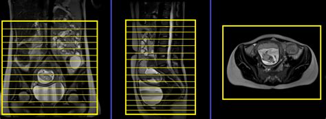 Mri Adnexal Mass In Pregnancy Adnexal Mass In Pregnancy Protocol