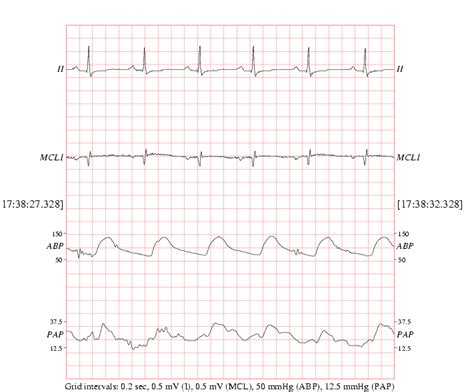 The MIMIC II Waveform Database