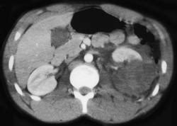 Renal Laceration - Kidney Case Studies - CTisus CT Scanning