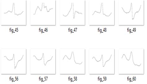 Atrial Rhythm Ventricular Ectopic Beat Download Scientific Diagram