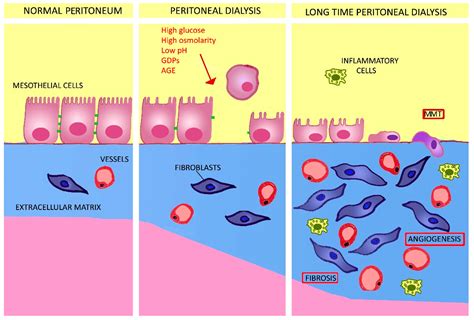 Peritoneal Dialysis Solution Hot Sex Picture