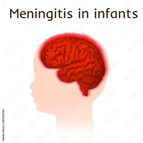 Meningitis In Infants Vector Medical Illustration Kid Baby