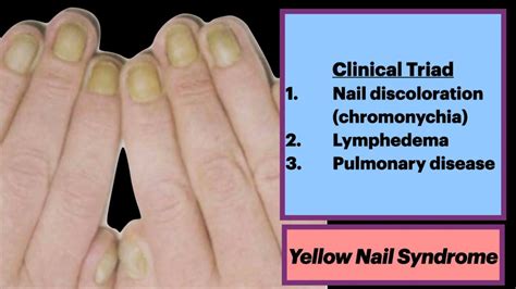 Update More Than 99 Yellow Nail Syndrome Triad Latest Vn