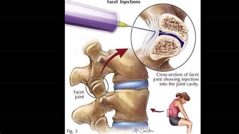 Cervical Radiofrequency Ablation Youtube