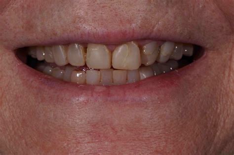 Replacement Of Failed Composite Veneers With Porcelain Veneers Dental