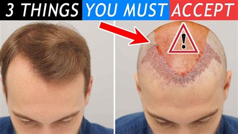 3 Things You Must Accept Before Your Hair Transplant Youtube