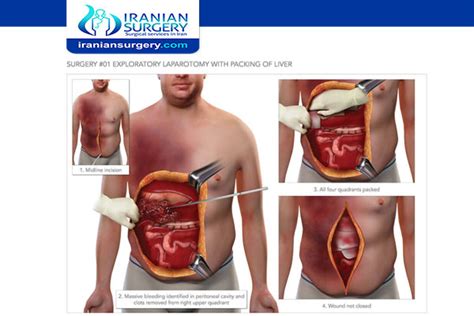 Ex Lap Surgery Ex Lap Exploratory Surgery Iranian Surgery