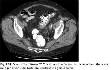 Diverticular abscess - Anaesthesia - European Medical Alliance