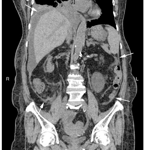 Glomerulonephritis led to chronic kidney failure in a 63-yearold woman... | Download Scientific ...