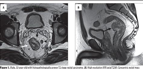 Rectal Cancer Staging Mri