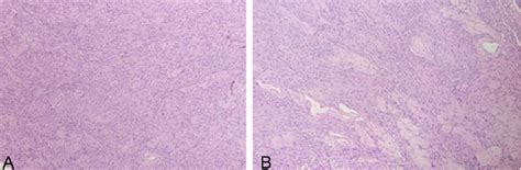 Figure From Retroperitoneal Pelvic Schwannoma A Rare Case Report And