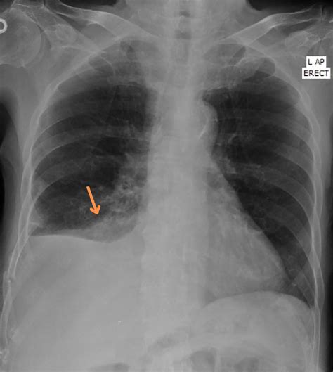 Figure From An Incidental Finding Of Lung Nodule In Patient