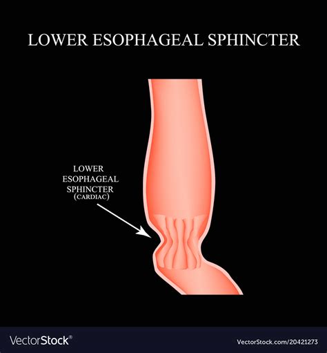 Lower Esophageal Sphincter Cardiac Sphincter