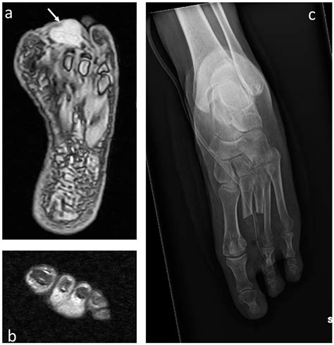 Jcm Free Full Text Malignant Bone And Soft Tissue Lesions Of The Foot