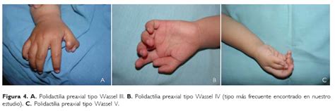 Experiencia con polidactilia preaxial en el Instituto Nacional de Pediatría