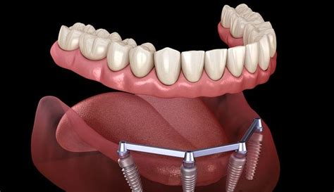 Exploring The Cost Of Denture Implants The Smile Clinics