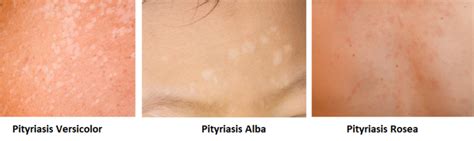 Pityriasis Versicolor Vlekjes Op De Huid Sproet