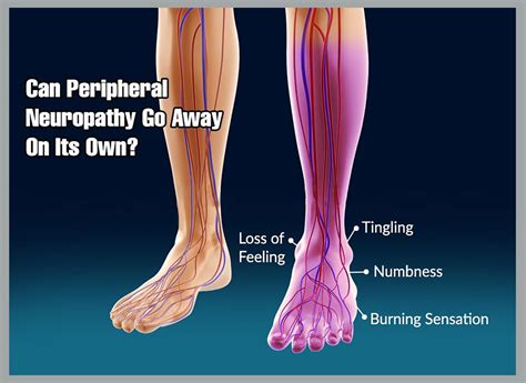 Does Neuropathy from Chemo Go Away? | Berkeley Institute International