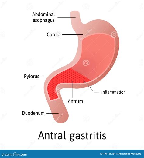 Antral Location Of Gastritis An Inflammation Of The Lining Of The Stomach Three Types Antral