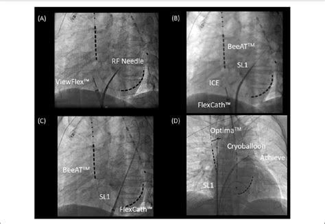 Representative Cryoballoon Cb Procedure In A Patient With Paroxysmal Download Scientific