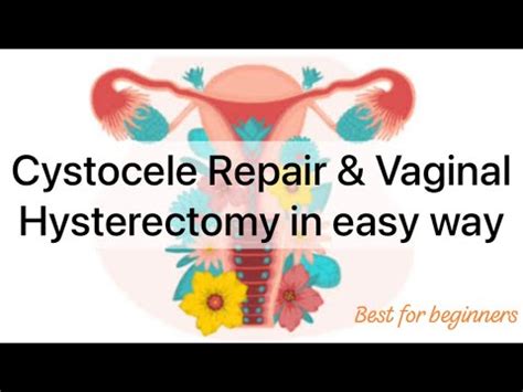 Cystocele Repair And Vaginal Hysterectomy In Easy Way Vh And Ap