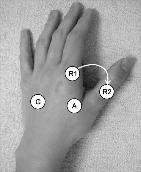 The Position Of The Reference Electrode In The Ulnar Motor Nerve