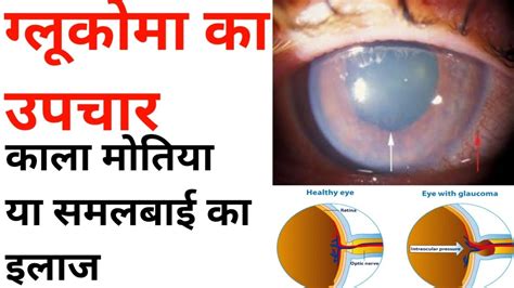 काला मोतिया Glaucoma का इलाज ।treatment Of Glaucoma।galucoma Ka Upchar । Youtube