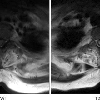 Axial view of the spinal MRI demonstrating thecal sac indentation and ...