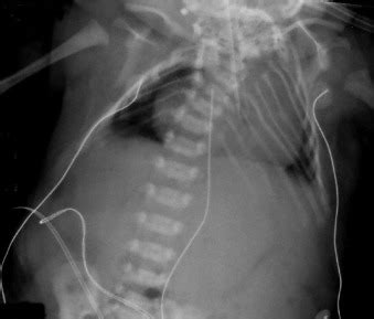 Spinal Abnormalities and Klippel-Feil Syndrome | Radiology Key