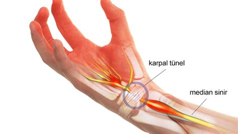 Karpal tünel sendromu nedir belirtileri nelerdir Karpal tünel