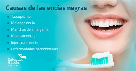 Causas Melanosis Gingival Clinica Dental Salvador Garc A Blog