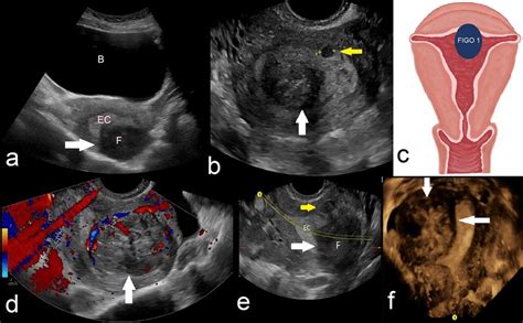 Figo 1—submucosal Leiomyoma With More Than 50 Submucosal Component And