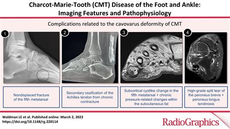 Charcot Marie Tooth Disease Of The Foot And Ankle Imaging Features And