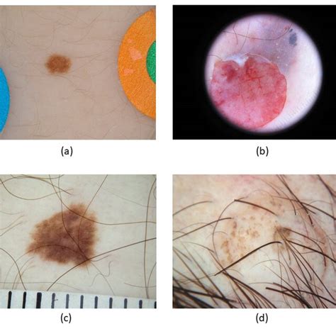 Examples Of Dermoscopic Images Of Skin Lesions With Artifacts A