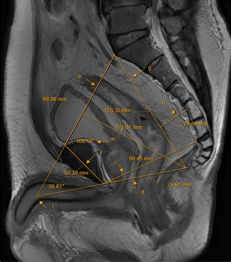 Sagittal Pelvic Magnetic Resonance Images A Anteroposterior Diameter