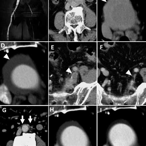 Magnetic Resonance Angiography Mra And Computed Tomography Ct Download Scientific Diagram