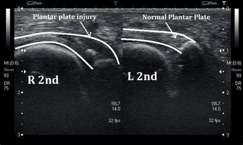 Plantar Fascia Tear Ultrasound