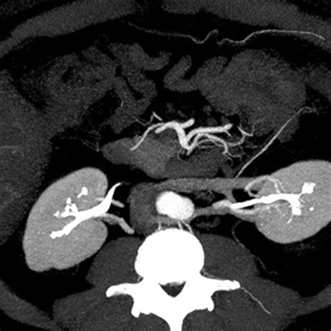 Combined Vascular Excretory Phase Mdct Angiography In The Preoperative