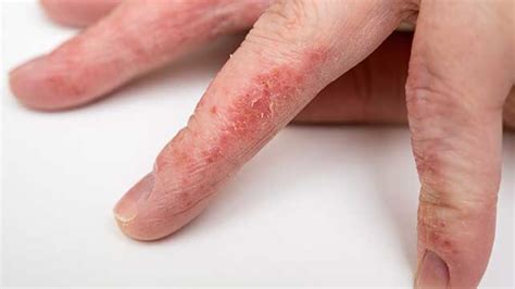 Eczema: Definition, Causes, Treatments, and Pictures