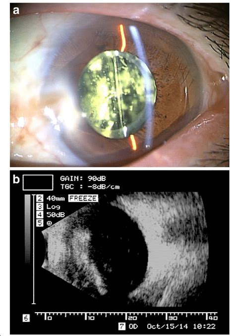 Eye Condition Asteroid Hyalosis