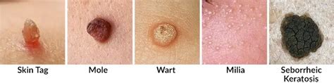 Skin Tags Causes Prevention Removal